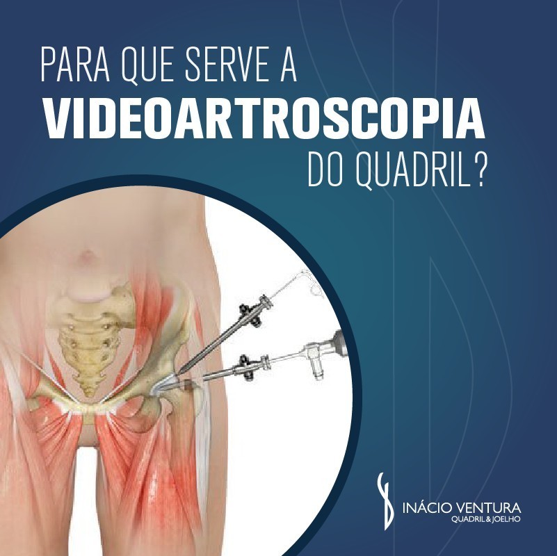 👨⚕️ A videoartroscopia do quadril tem o objetivo de tratar dores e lesões em estágio precoce,…