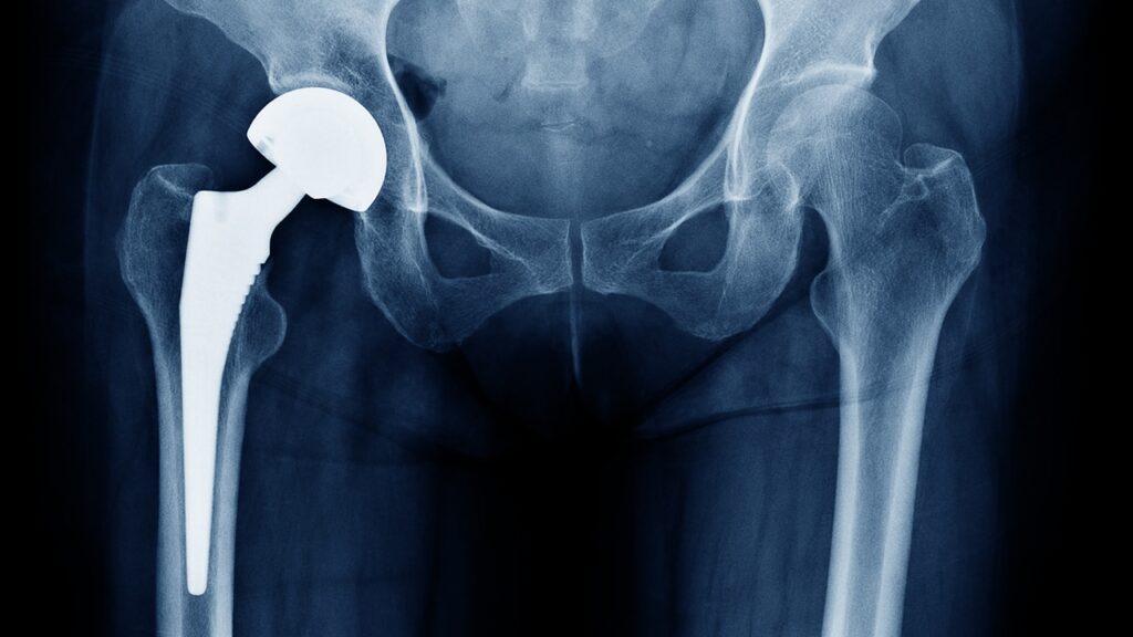 Cirurgia de Prótese de Quadril: Superando o Medo e Melhorando a Qualidade de Vida